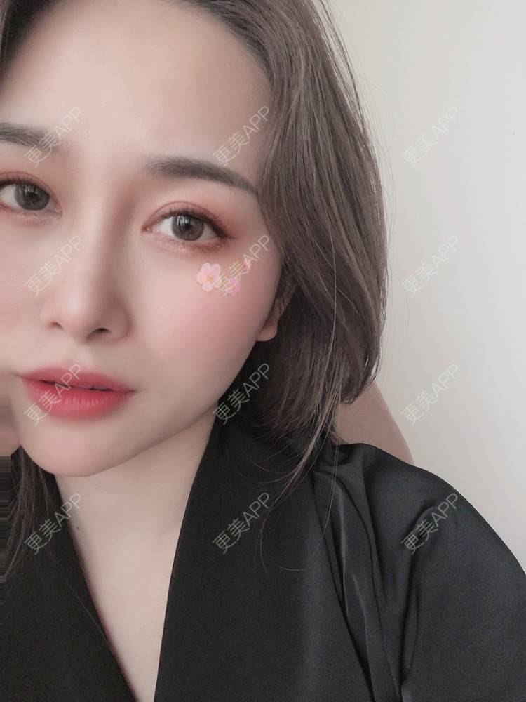 更美 - 甜心泡芙的双眼皮修复经验 | 双眼皮 | 全切双眼皮 | 开内眼角 | 重庆 | 双眼皮修复