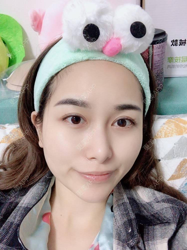 更美 - 甜心泡芙的双眼皮修复经验 | 双眼皮 | 全切双眼皮 | 开内眼角 | 重庆 | 双眼皮修复