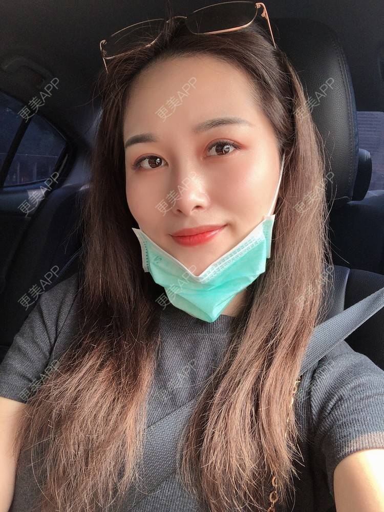 更美 - 甜心泡芙的双眼皮修复经验 | 双眼皮 | 全切双眼皮 | 开内眼角 | 重庆 | 双眼皮修复