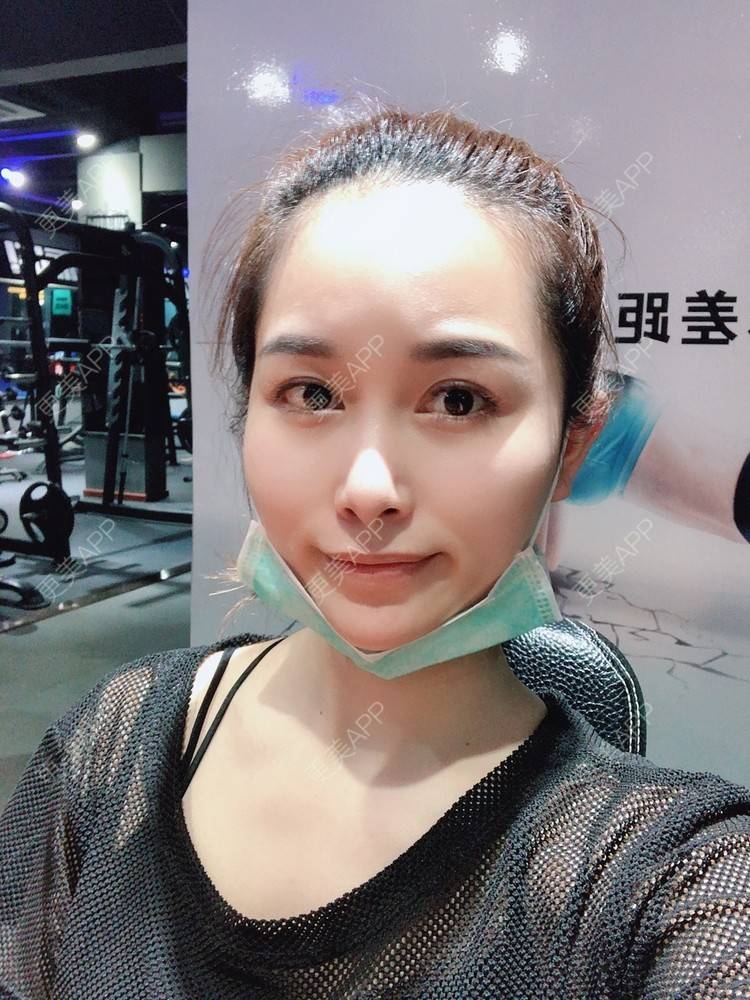 更美 - 甜心泡芙的双眼皮修复经验 | 双眼皮 | 全切双眼皮 | 开内眼角 | 重庆 | 双眼皮修复