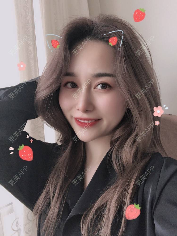 更美 - 甜心泡芙的双眼皮修复经验 | 双眼皮 | 全切双眼皮 | 开内眼角 | 重庆 | 双眼皮修复