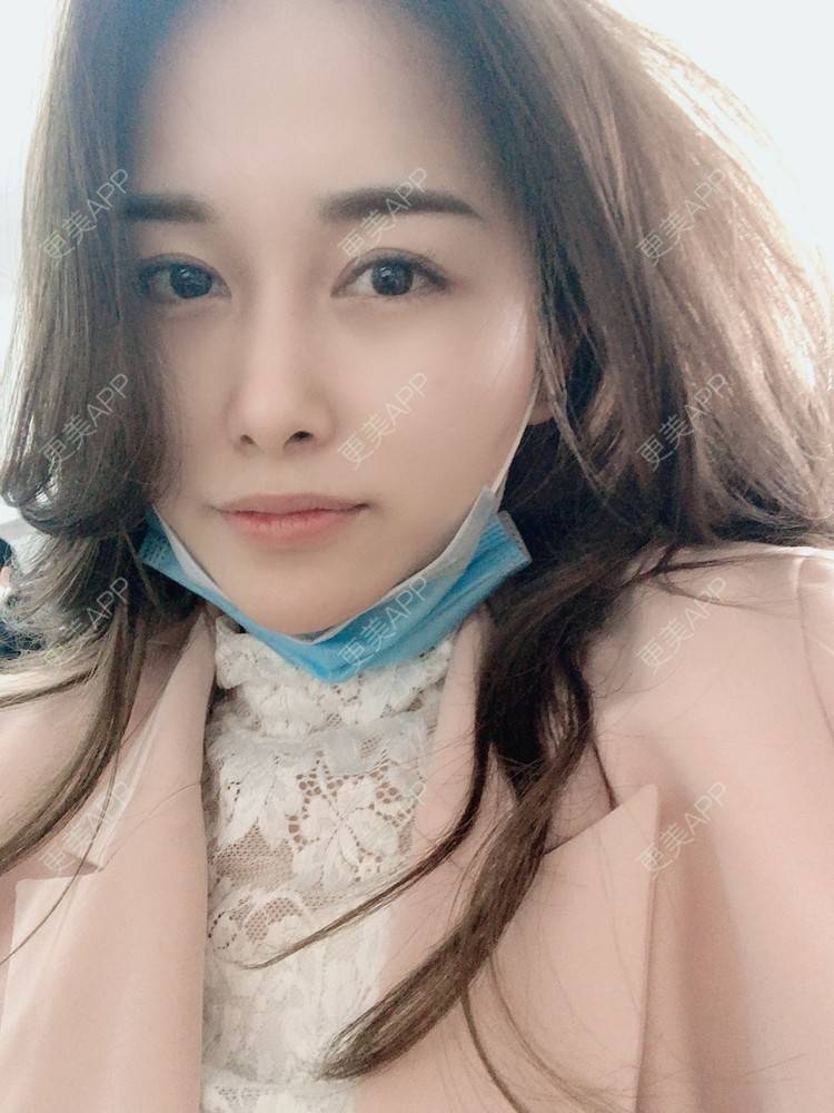 更美 - 甜心泡芙的双眼皮修复经验 | 双眼皮 | 全切双眼皮 | 开内眼角 | 重庆 | 双眼皮修复