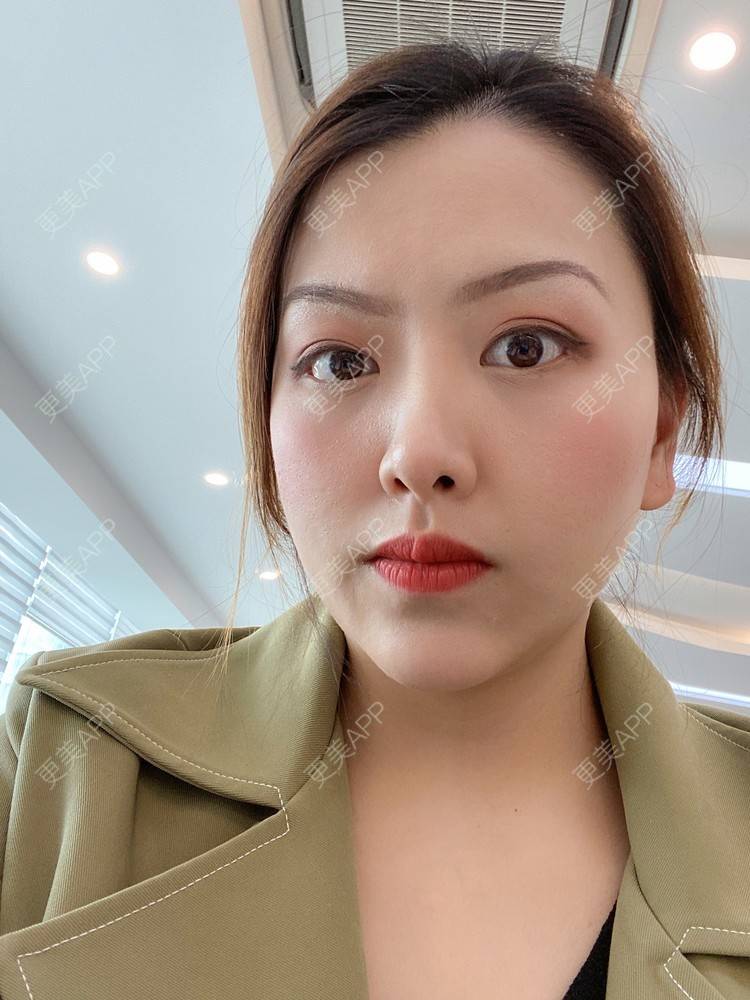 更美 - 夹心巧克力的膨体垫下巴经验 | 下巴 | 玻尿酸下巴 | 下巴截骨前移 | 自体脂肪垫下巴 | 硅胶垫下巴 | 膨体垫下巴 | 缩下巴 | 胶原蛋白丰下巴 | 人工骨垫下巴