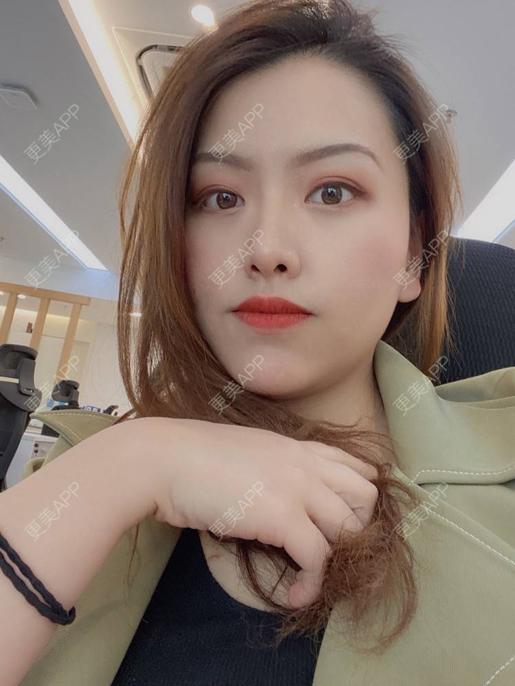 更美 - 夹心巧克力的膨体垫下巴经验 | 下巴 | 玻尿酸下巴 | 下巴截骨前移 | 自体脂肪垫下巴 | 硅胶垫下巴 | 膨体垫下巴 | 缩下巴 | 胶原蛋白丰下巴 | 人工骨垫下巴