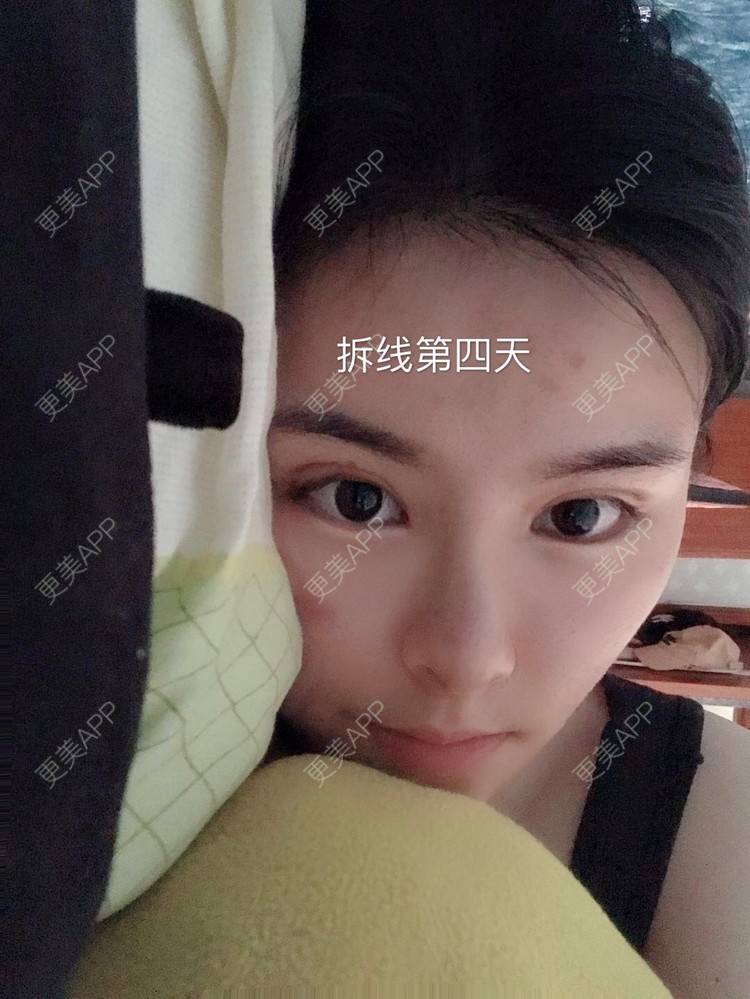 更美 - 长沙市希美医疗美容的鼻部多项经验 | 鼻部多项 | 长沙