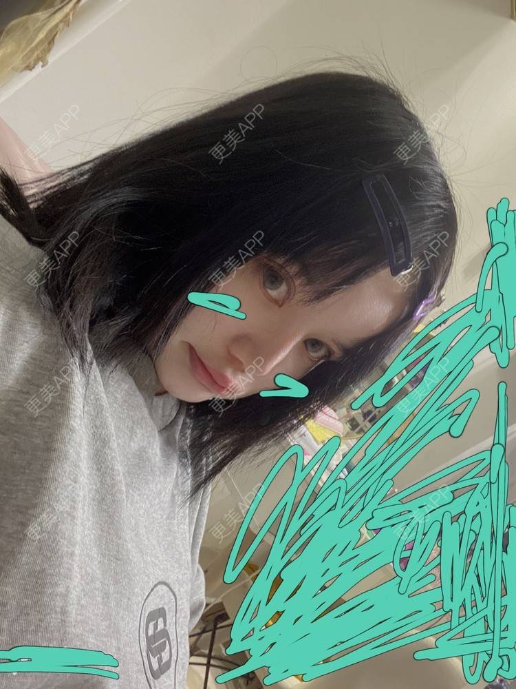 更美 - 更美用户qPl9XqbpZ9的洗眼线经验 | 激光洗纹身 | 郑州 | 洗眼线