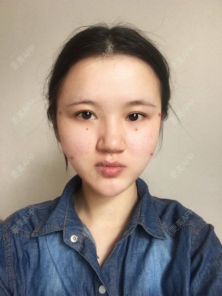 更美 - 更美用户T8WaNbmjvG的热玛吉经验 | 埋线提升 | 热玛吉 | 超声提升 | 热拉提 | 深圳