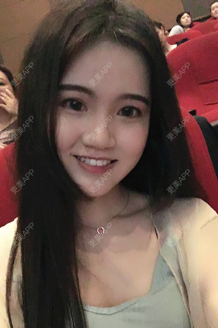 更美 - 更美用户T8WaNbmjvG的热玛吉经验 | 深圳 | 热玛吉 | 超声提升 | 埋线提升 | 热拉提