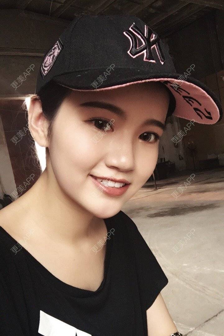 更美 - 更美用户T8WaNbmjvG的热玛吉经验 | 深圳 | 热玛吉 | 超声提升 | 埋线提升 | 热拉提