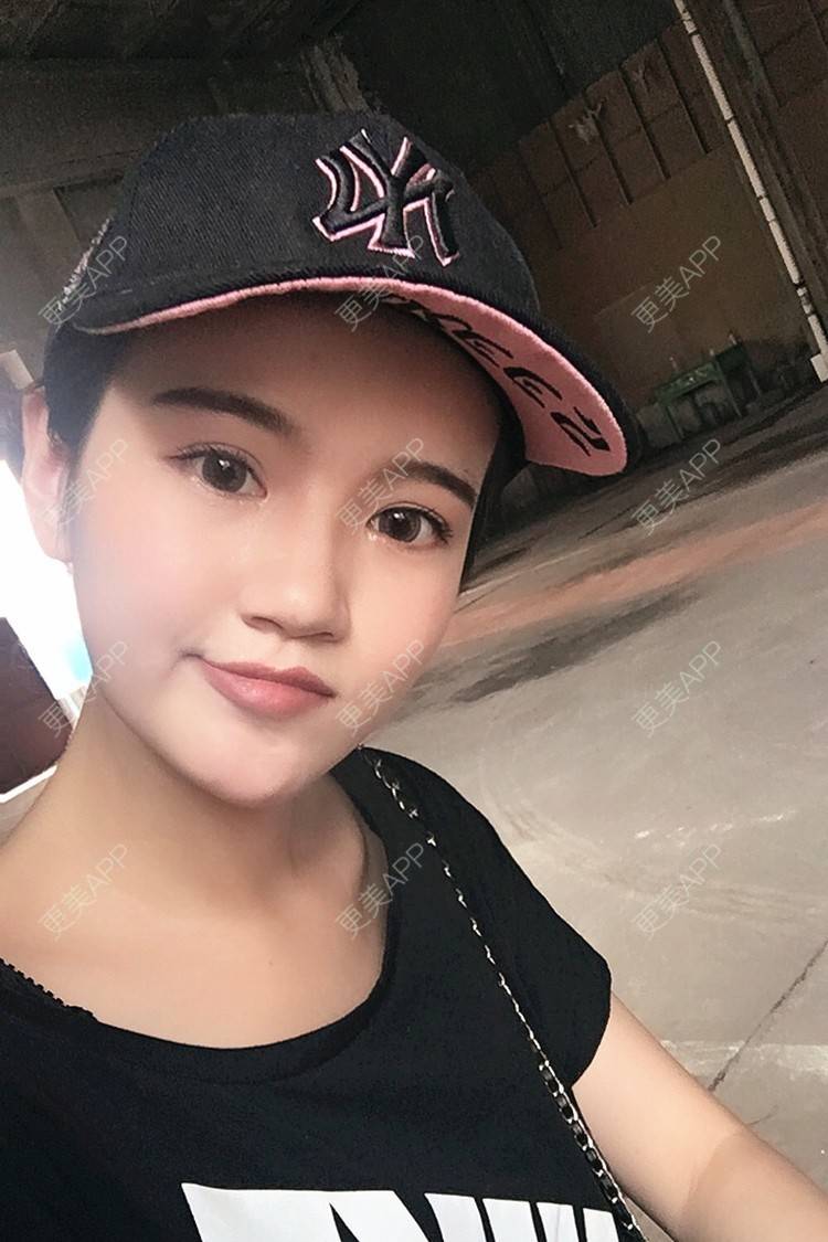 更美 - 更美用户T8WaNbmjvG的热玛吉经验 | 深圳 | 热玛吉 | 超声提升 | 埋线提升 | 热拉提