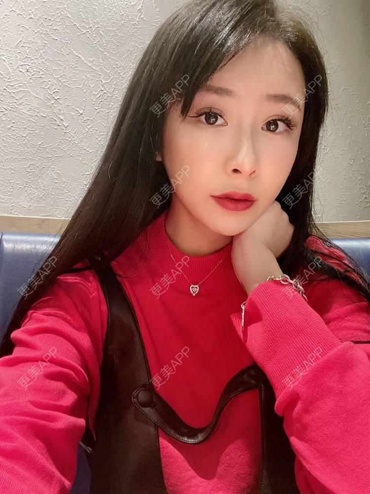 更美 - 兰质慧心的自体脂肪丰苹果肌经验 | 视频日记 | 自体脂肪丰面颊 | 上海 | 自体脂肪丰苹果肌 | 自体脂肪垫下巴