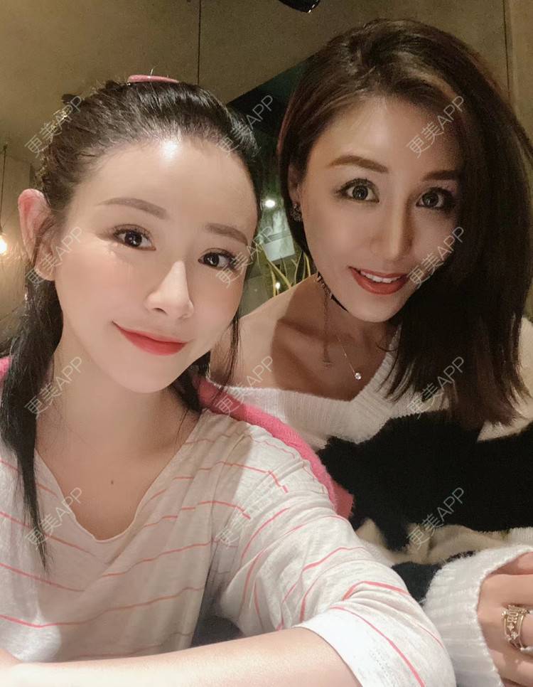 更美 - 兰质慧心的自体脂肪丰苹果肌经验 | 视频日记 | 自体脂肪丰面颊 | 上海 | 自体脂肪丰苹果肌 | 自体脂肪垫下巴