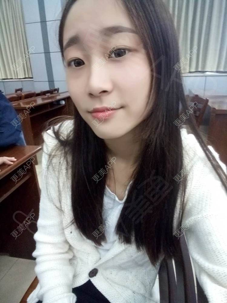 更美 - 半夏0的双眼皮经验 | 双眼皮 | 更美研究所 | 大腿脱毛 | 成都 | 视频日记