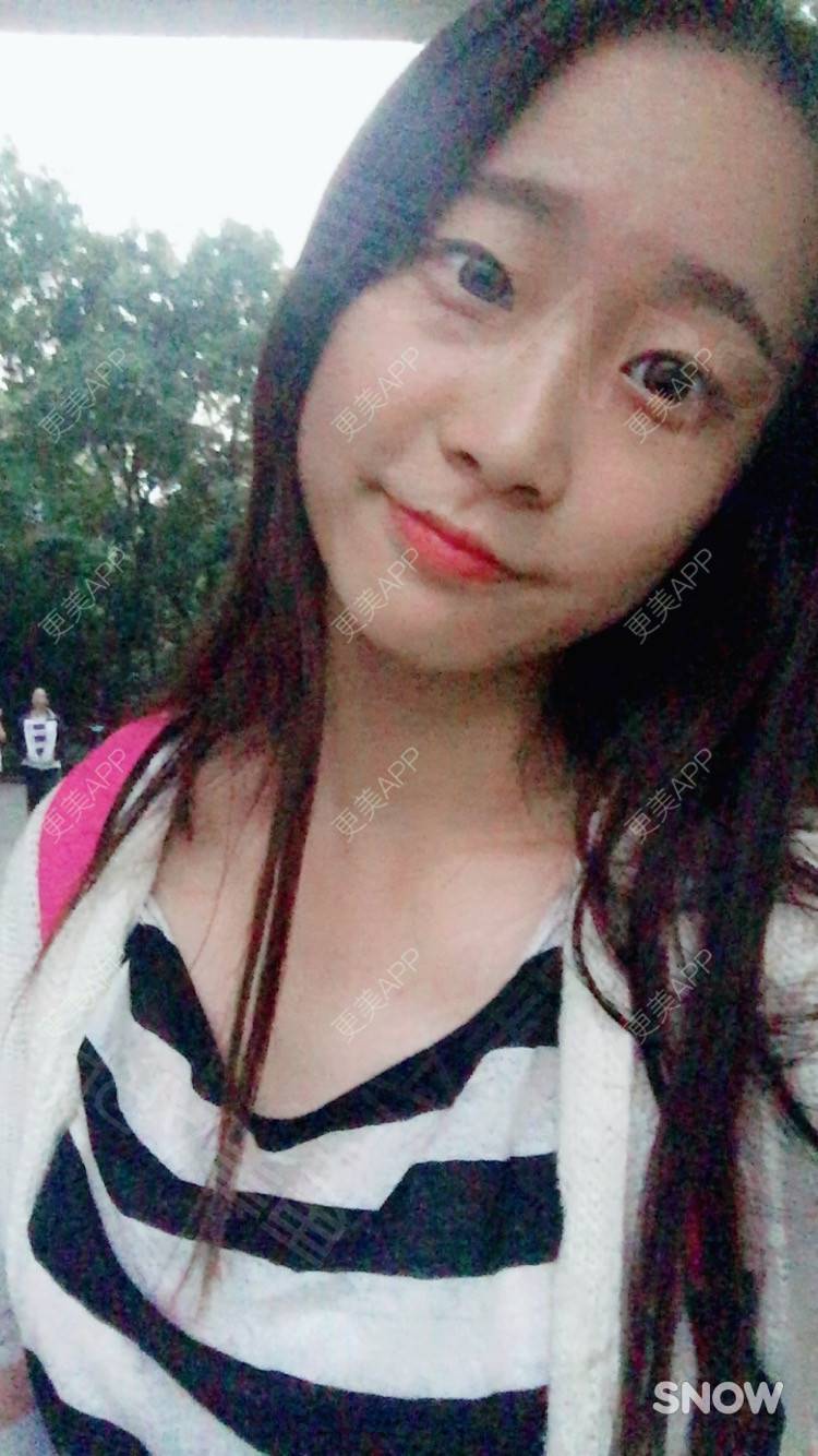 更美 - 半夏0的双眼皮经验 | 双眼皮 | 更美研究所 | 大腿脱毛 | 成都 | 视频日记