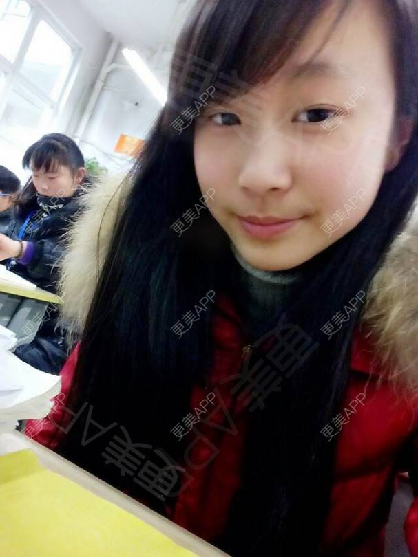 更美 - 半夏0的双眼皮经验 | 双眼皮 | 更美研究所 | 大腿脱毛 | 成都 | 视频日记