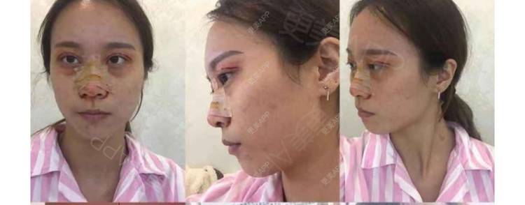 更美 - 半夏0的双眼皮经验 | 双眼皮 | 更美研究所 | 大腿脱毛 | 成都 | 视频日记
