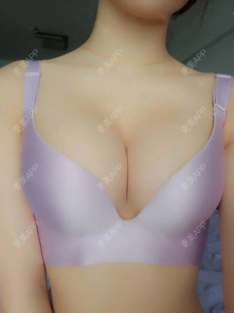 更美 - 更美用户2o60cQKUEs的假体隆胸经验 | 假体隆胸 | 乳头再造 | 美胸套餐 | 重庆