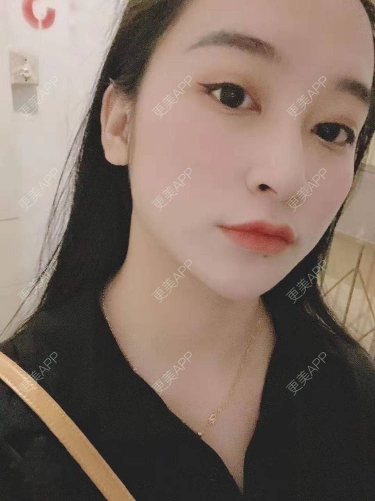 更美 - 更美用户129LF9Yh6a的玻尿酸下巴经验 | 视频日记 | 玻尿酸下巴 | 广州