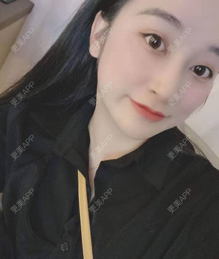 更美 - 更美用户129LF9Yh6a的玻尿酸下巴经验 | 视频日记 | 玻尿酸下巴 | 广州