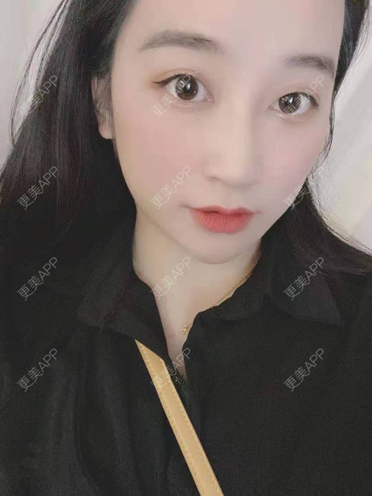 更美 - 更美用户129LF9Yh6a的玻尿酸下巴经验 | 视频日记 | 玻尿酸下巴 | 广州