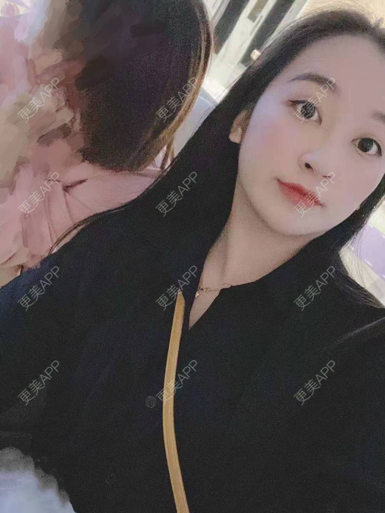 更美 - 更美用户129LF9Yh6a的玻尿酸下巴经验 | 视频日记 | 玻尿酸下巴 | 广州