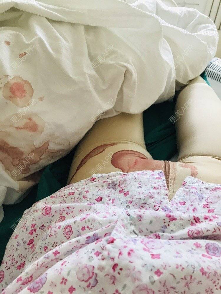更美 - 🐻可爱嘚、布鲁鲁的吸脂去副乳经验 | 自体脂肪隆胸 | 吸脂去副乳 | 北京