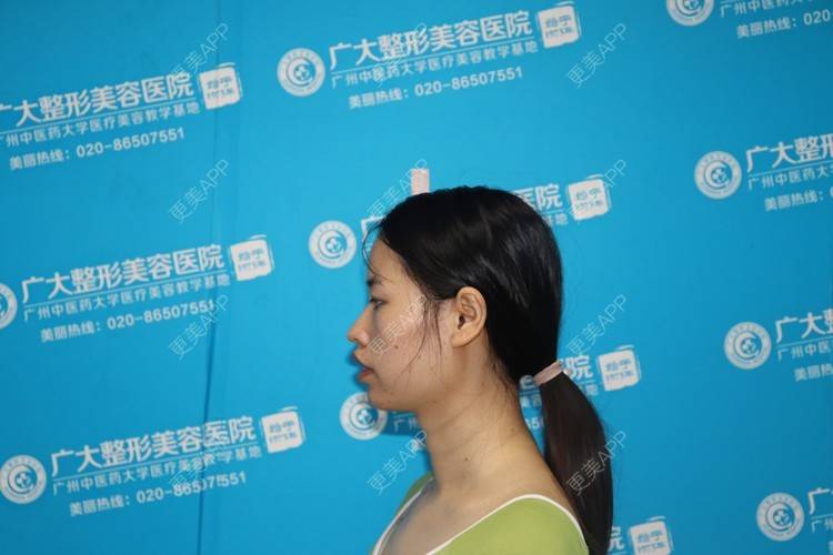 更美 - 爱演的逗比的凸嘴矫正经验 | 凸嘴矫正 | 面部不对称矫正 | 广州