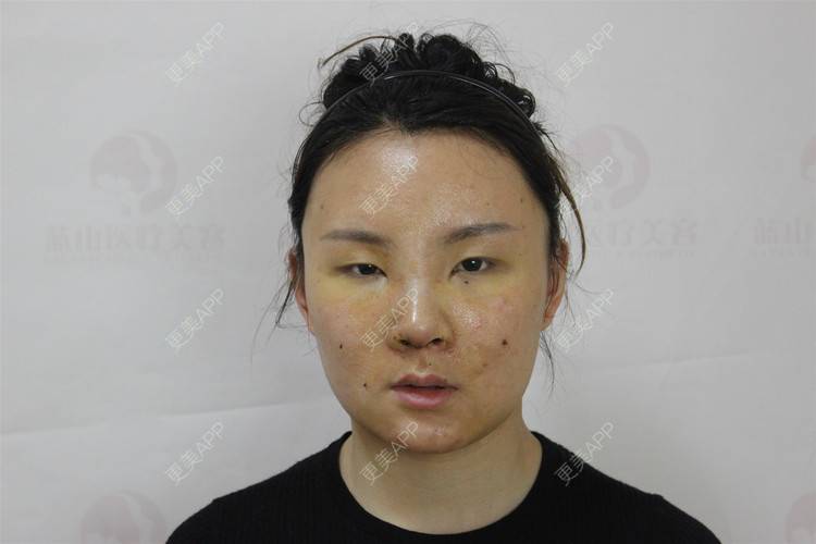 更美 - 保定市竞秀区蓝山医疗美容医院的隆鼻经验 | 隆鼻