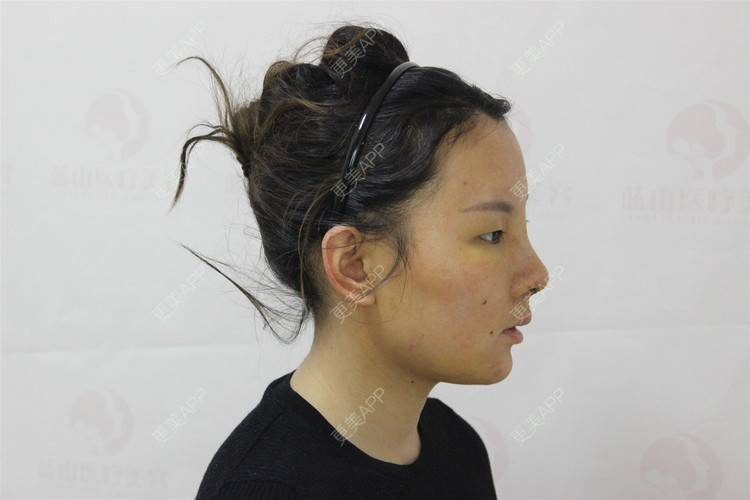 更美 - 保定市竞秀区蓝山医疗美容医院的隆鼻经验 | 隆鼻