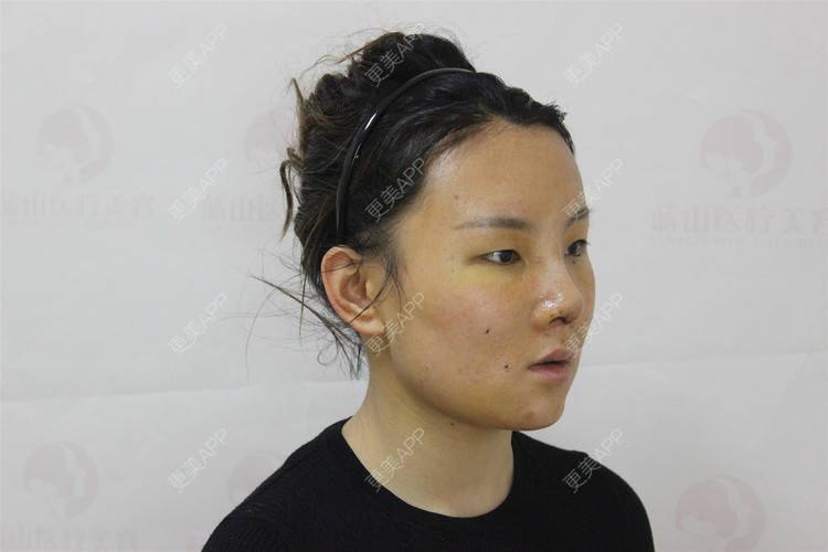 更美 - 保定市竞秀区蓝山医疗美容医院的隆鼻经验 | 隆鼻