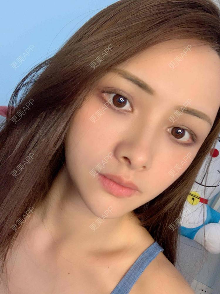 更美 - 假装很正经的自体脂肪丰苹果肌经验 | 自体脂肪全面部填充 | 视频日记 | 自体脂肪丰面颊 | 自体脂肪丰苹果肌 | 广州