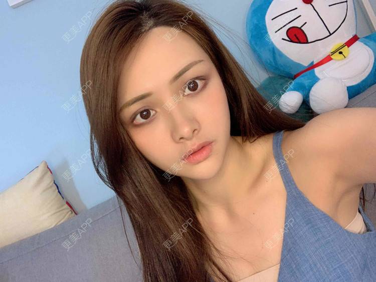 更美 - 假装很正经的自体脂肪丰苹果肌经验 | 自体脂肪全面部填充 | 视频日记 | 自体脂肪丰面颊 | 自体脂肪丰苹果肌 | 广州