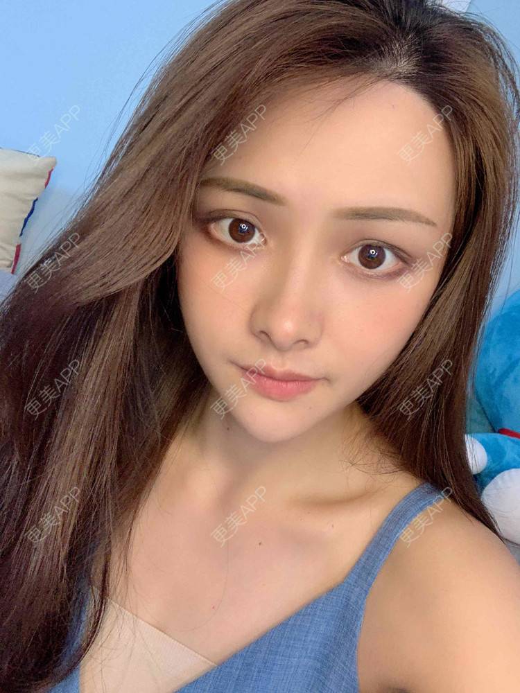 更美 - 假装很正经的自体脂肪丰苹果肌经验 | 自体脂肪全面部填充 | 视频日记 | 自体脂肪丰面颊 | 自体脂肪丰苹果肌 | 广州