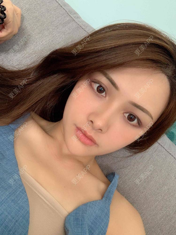 更美 - 假装很正经的自体脂肪丰苹果肌经验 | 自体脂肪全面部填充 | 视频日记 | 自体脂肪丰面颊 | 自体脂肪丰苹果肌 | 广州