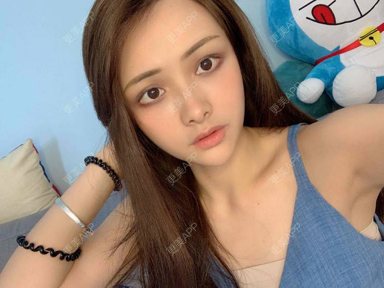 更美 - 假装很正经的自体脂肪丰苹果肌经验 | 自体脂肪全面部填充 | 视频日记 | 自体脂肪丰面颊 | 自体脂肪丰苹果肌 | 广州