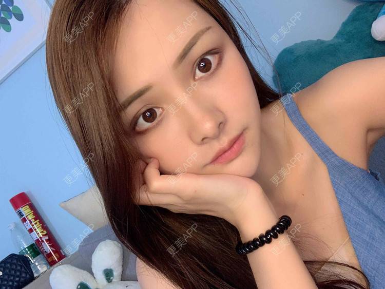 更美 - 假装很正经的自体脂肪丰苹果肌经验 | 自体脂肪全面部填充 | 视频日记 | 自体脂肪丰面颊 | 自体脂肪丰苹果肌 | 广州