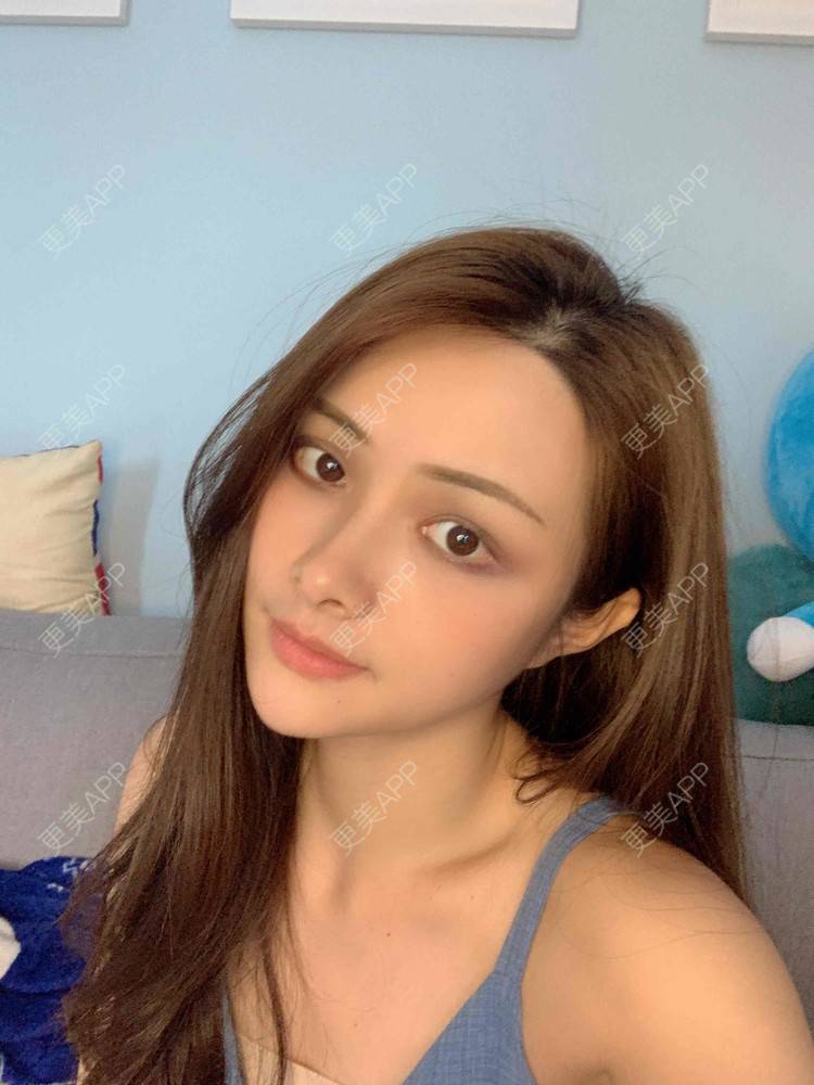 更美 - 假装很正经的自体脂肪丰苹果肌经验 | 自体脂肪全面部填充 | 视频日记 | 自体脂肪丰面颊 | 自体脂肪丰苹果肌 | 广州