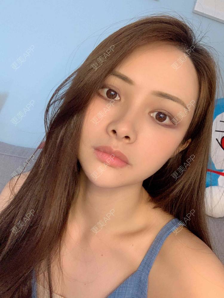 更美 - 假装很正经的自体脂肪丰苹果肌经验 | 自体脂肪全面部填充 | 视频日记 | 自体脂肪丰面颊 | 自体脂肪丰苹果肌 | 广州