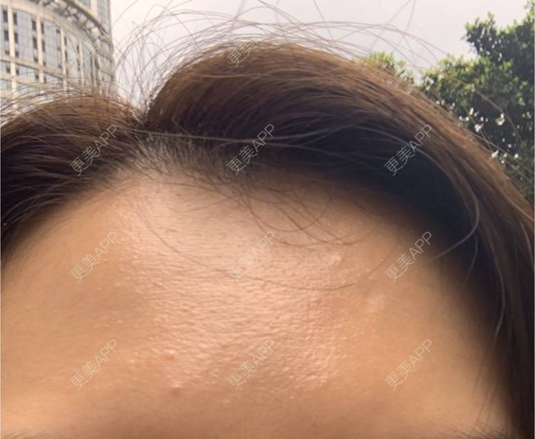 更美 - 更美用户CUVg97dlGa的微针水光经验 | 重庆 | 微针水光