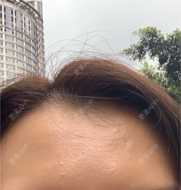 更美 - 更美用户CUVg97dlGa的微针水光经验 | 重庆 | 微针水光