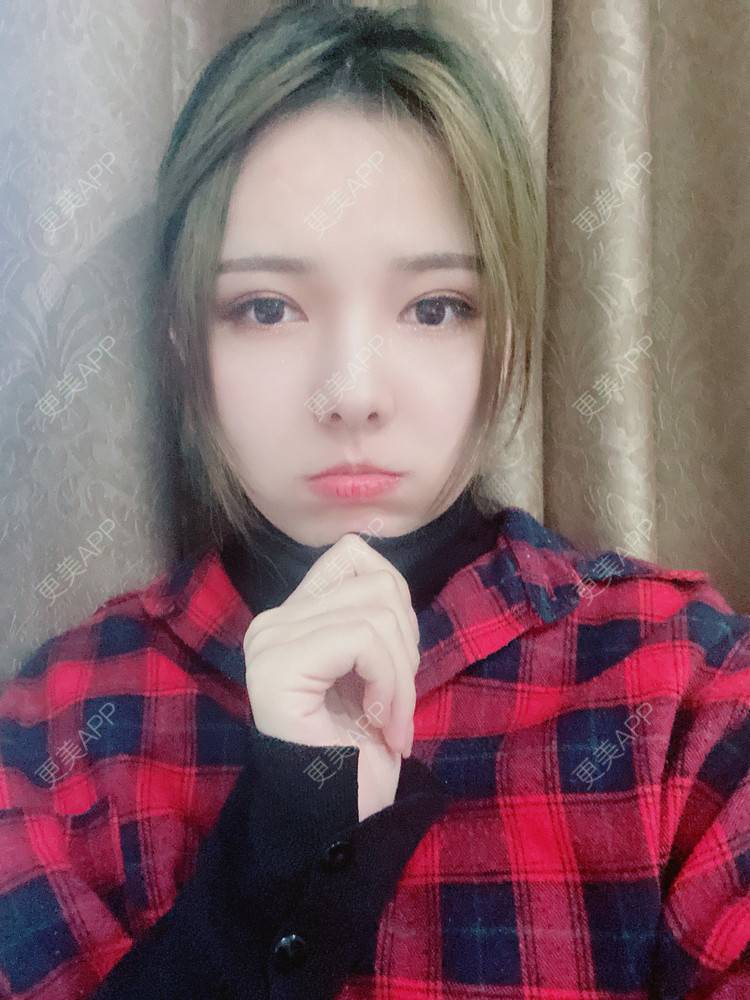 更美 - Zjxiaokeai的全切双眼皮经验 | 全切双眼皮 | 开内眼角 | 眼皮下垂矫正 | 重庆 | 双眼皮修复 | 上眼睑去脂 | 眼部多项