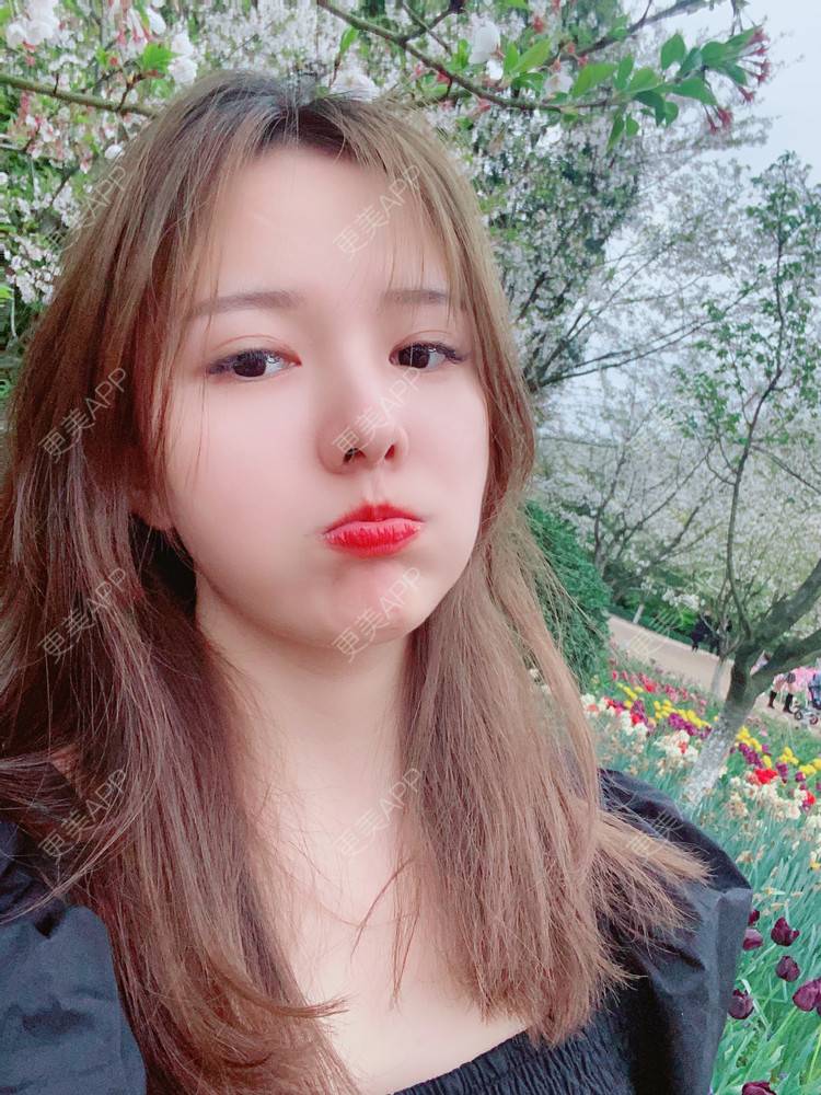 更美 - Zjxiaokeai的全切双眼皮经验 | 全切双眼皮 | 开内眼角 | 眼皮下垂矫正 | 重庆 | 双眼皮修复 | 上眼睑去脂 | 眼部多项