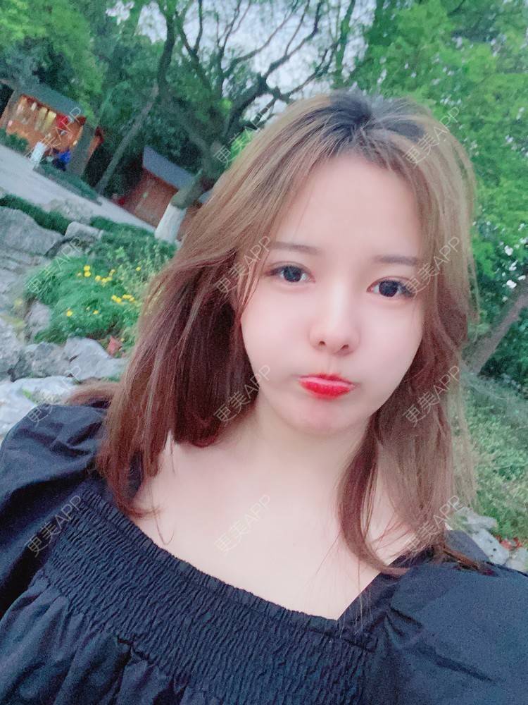 更美 - Zjxiaokeai的全切双眼皮经验 | 全切双眼皮 | 开内眼角 | 眼皮下垂矫正 | 重庆 | 双眼皮修复 | 上眼睑去脂 | 眼部多项