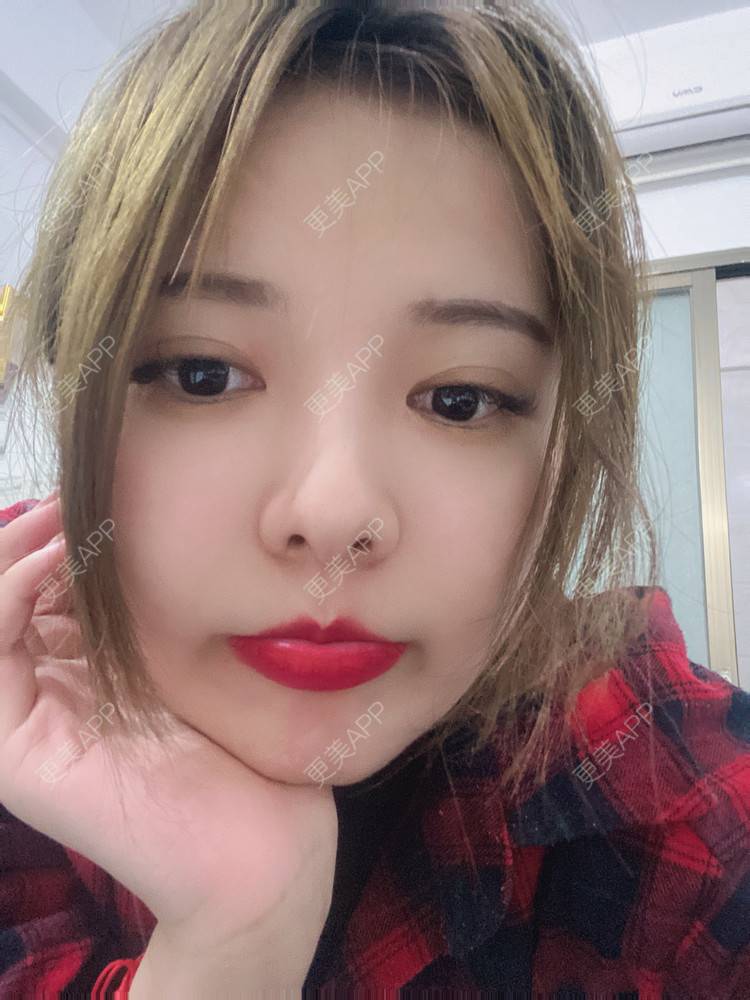 更美 - Zjxiaokeai的全切双眼皮经验 | 全切双眼皮 | 开内眼角 | 眼皮下垂矫正 | 重庆 | 双眼皮修复 | 上眼睑去脂 | 眼部多项