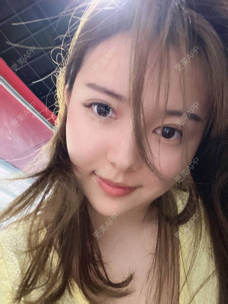 更美 - Zjxiaokeai的全切双眼皮经验 | 全切双眼皮 | 开内眼角 | 眼皮下垂矫正 | 重庆 | 双眼皮修复 | 上眼睑去脂 | 眼部多项