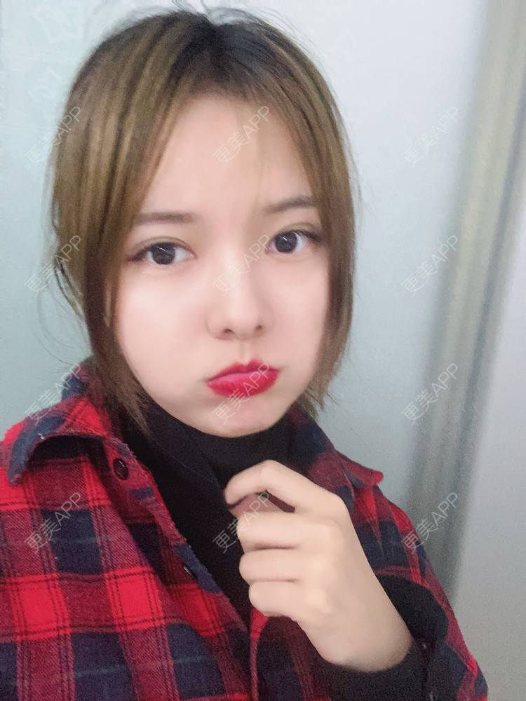 更美 - Zjxiaokeai的全切双眼皮经验 | 全切双眼皮 | 开内眼角 | 眼皮下垂矫正 | 重庆 | 双眼皮修复 | 上眼睑去脂 | 眼部多项