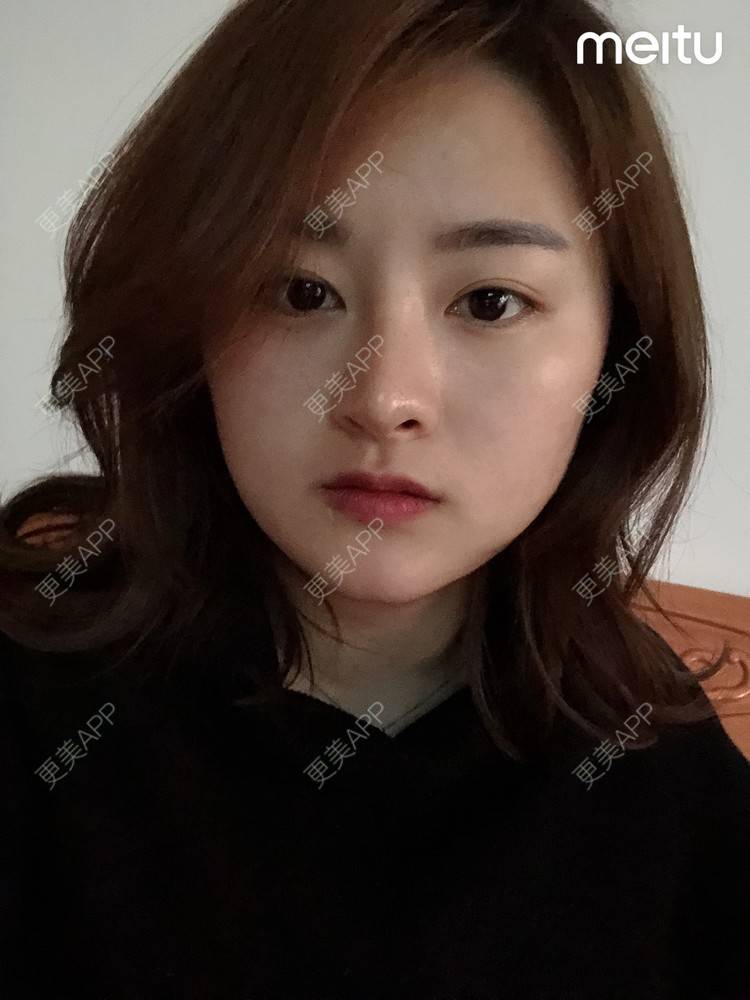 更美 - 浑身上下的肋软骨隆鼻经验 | 更美研究所 | 杭州 | 肋软骨隆鼻 | 隆鼻