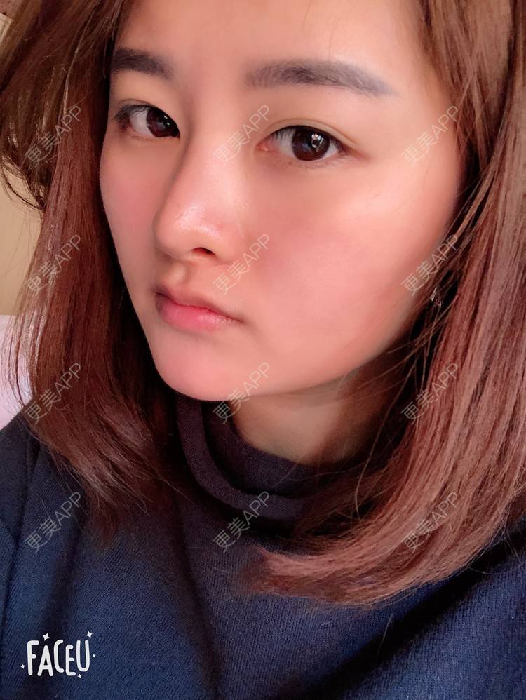 更美 - 浑身上下的肋软骨隆鼻经验 | 更美研究所 | 杭州 | 肋软骨隆鼻 | 隆鼻