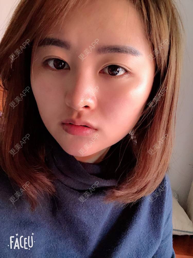 更美 - 浑身上下的肋软骨隆鼻经验 | 更美研究所 | 杭州 | 肋软骨隆鼻 | 隆鼻