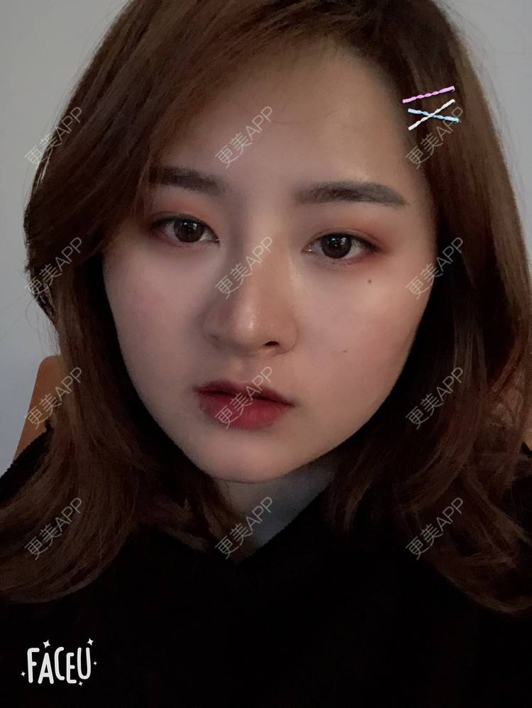 更美 - 浑身上下的肋软骨隆鼻经验 | 更美研究所 | 杭州 | 肋软骨隆鼻 | 隆鼻